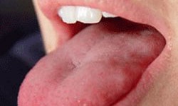 زخم زبان سرطان می آورد!