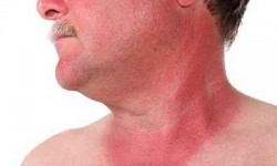 آفتاب سوختگی و درمان های خانگی موثر